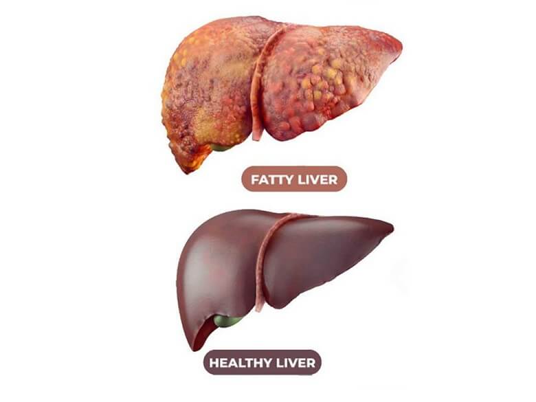 توت کبد چرب را درمان می‌کند.