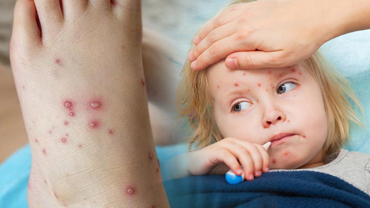 هشدار اپیدمی جدید بعد از آبله میمون! این‌بار تب گوجه‌فرنگی!