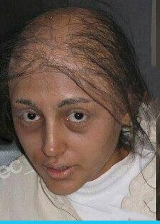 چهره سرطانی گلشیفته چهره سرطانی گلشیفته