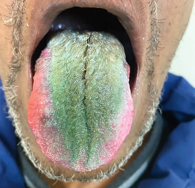 عکس/ زبان مرد سیگاری مو درآورد! عکس/ زبان مرد سیگاری مو درآورد!