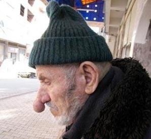 مرد 80 ساله ترکیه‌ای با 14 سانتی‌متر بینی، صاحب درازترین بینی دنیاست.